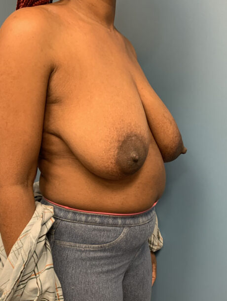 Breast Reduction case #2800