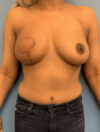 DIEP Flap case #2639
