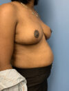Breast Reduction case #2800