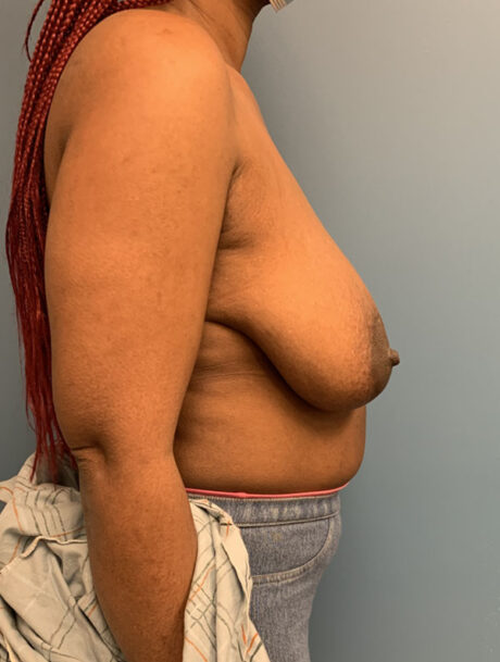 Breast Reduction case #2800