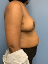 Breast Reduction case #2800
