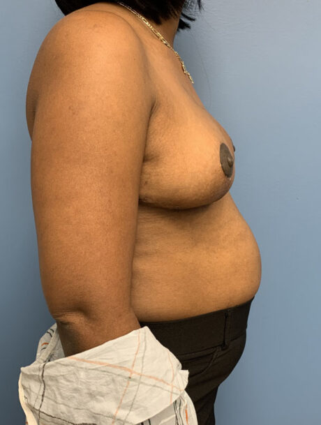 Breast Reduction case #2800