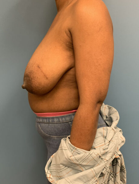 Breast Reduction case #2800
