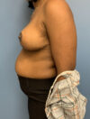Breast Reduction case #2800