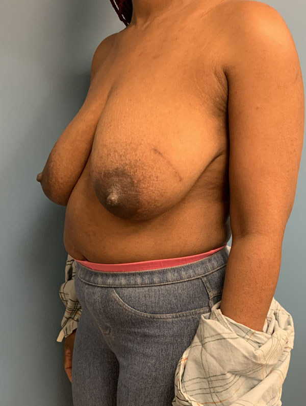 Breast Reduction case #2800