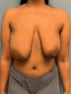 Breast Reduction case #2812