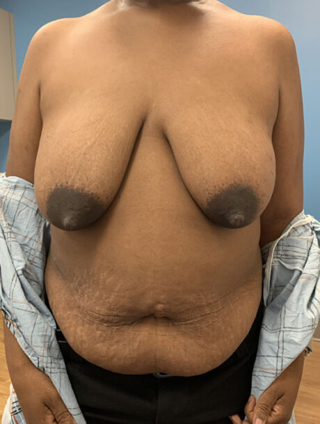 DIEP Flap case #2642