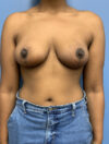 Breast Reduction case #2812