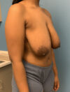 Breast Reduction case #2812